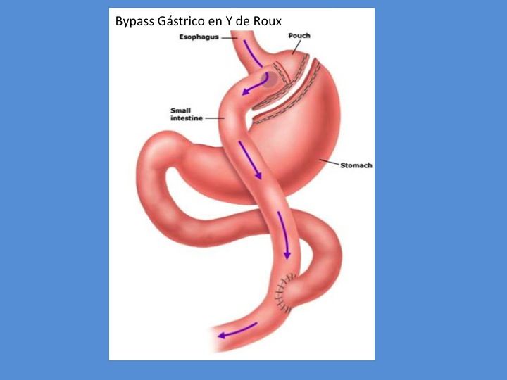 Bypass-gástrico-en-Y-de-Roux