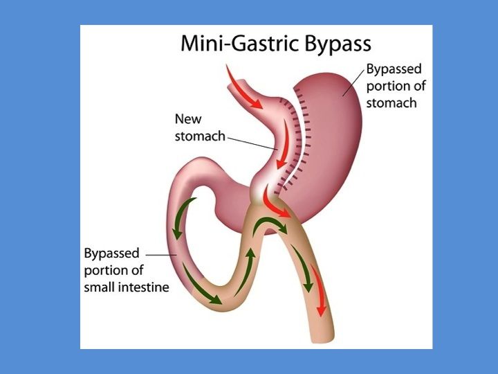 mini-gastric-bypass