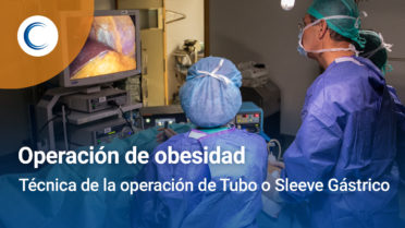 Cómo realizamos la operación de Tubo o Manga gástrica