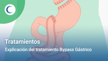 Explicación del tratamiento Bypass Gástrico