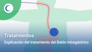 Explicación tratamiento balón intragástrico