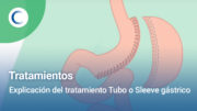 Explicación del tratamiento de Tubo o Manga gástrica