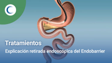 Explicación retirada Endoscópica del Endobarrier