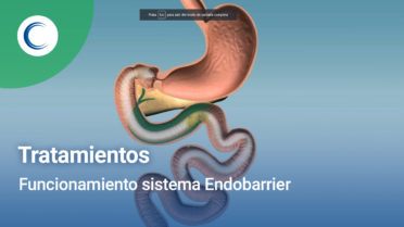 Funcionamiento sistema Endobarrier