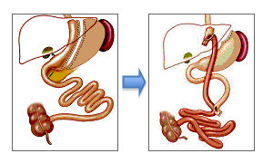 Cirugia de revision: paso de tubo gástrico a bypass gástrico
