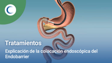 Explicación de la colocación endoscópica del Endobarrier