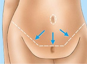 abdominoplastia