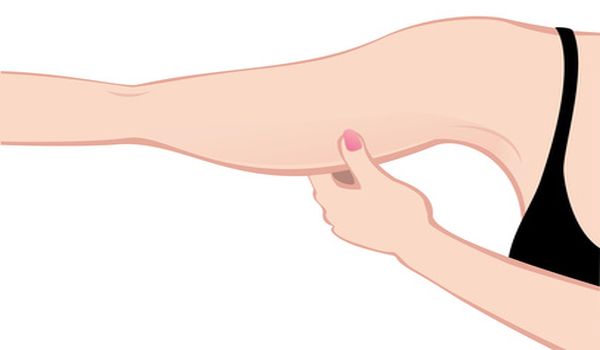 Braquioplastia