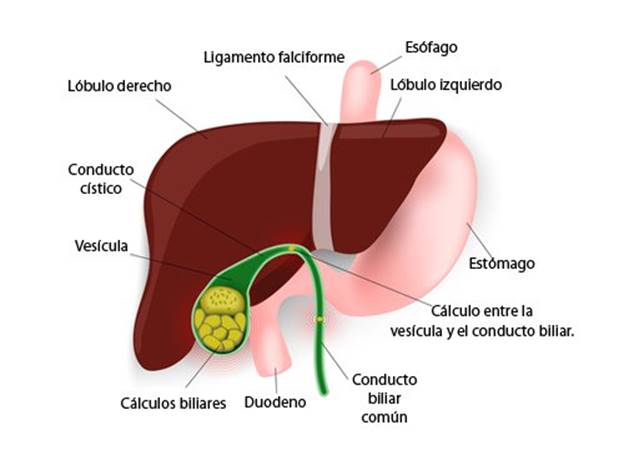 Cálculos en la vesícula Cálculos en la vesícula