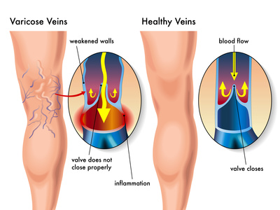 prevenir y tratar las varices