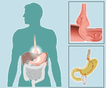 Hernia de Hiato • Clínica Obésitas Hernia de Hiato • Clínica Obésitas