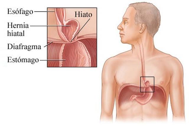 Menu dieta para hernia hiatal